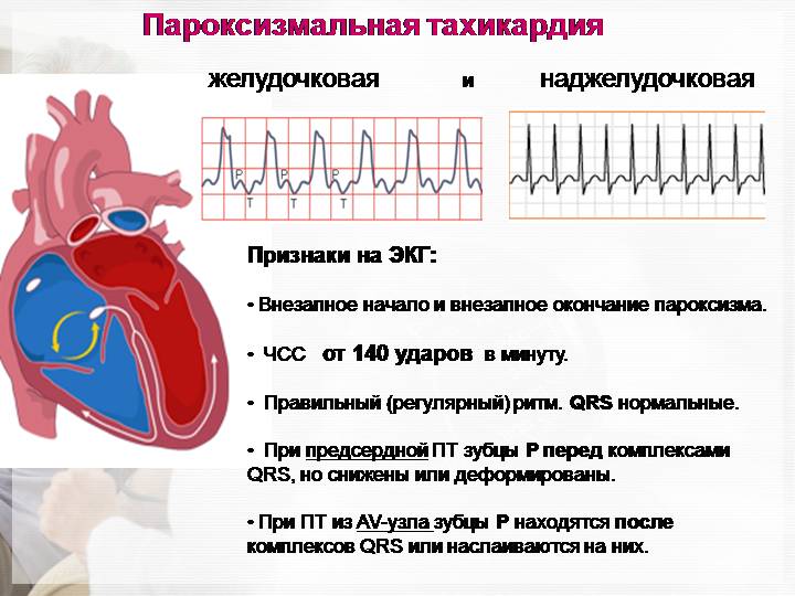 paroksizmalnaya-tahikardiya.jpg