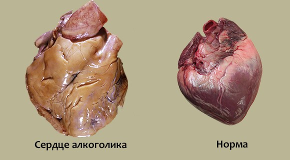 Как алкоголь влияет на сердечно-сосудистую систему